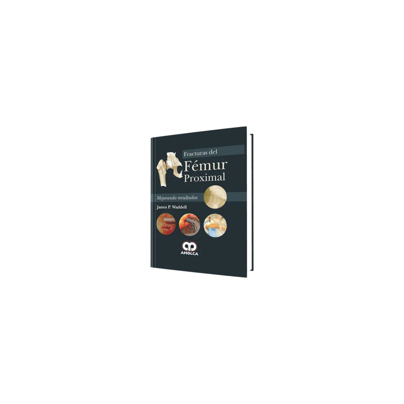 Fracturas del Fémur Proximal
