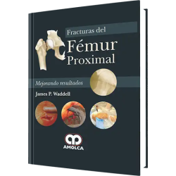 Fracturas del Fémur Proximal